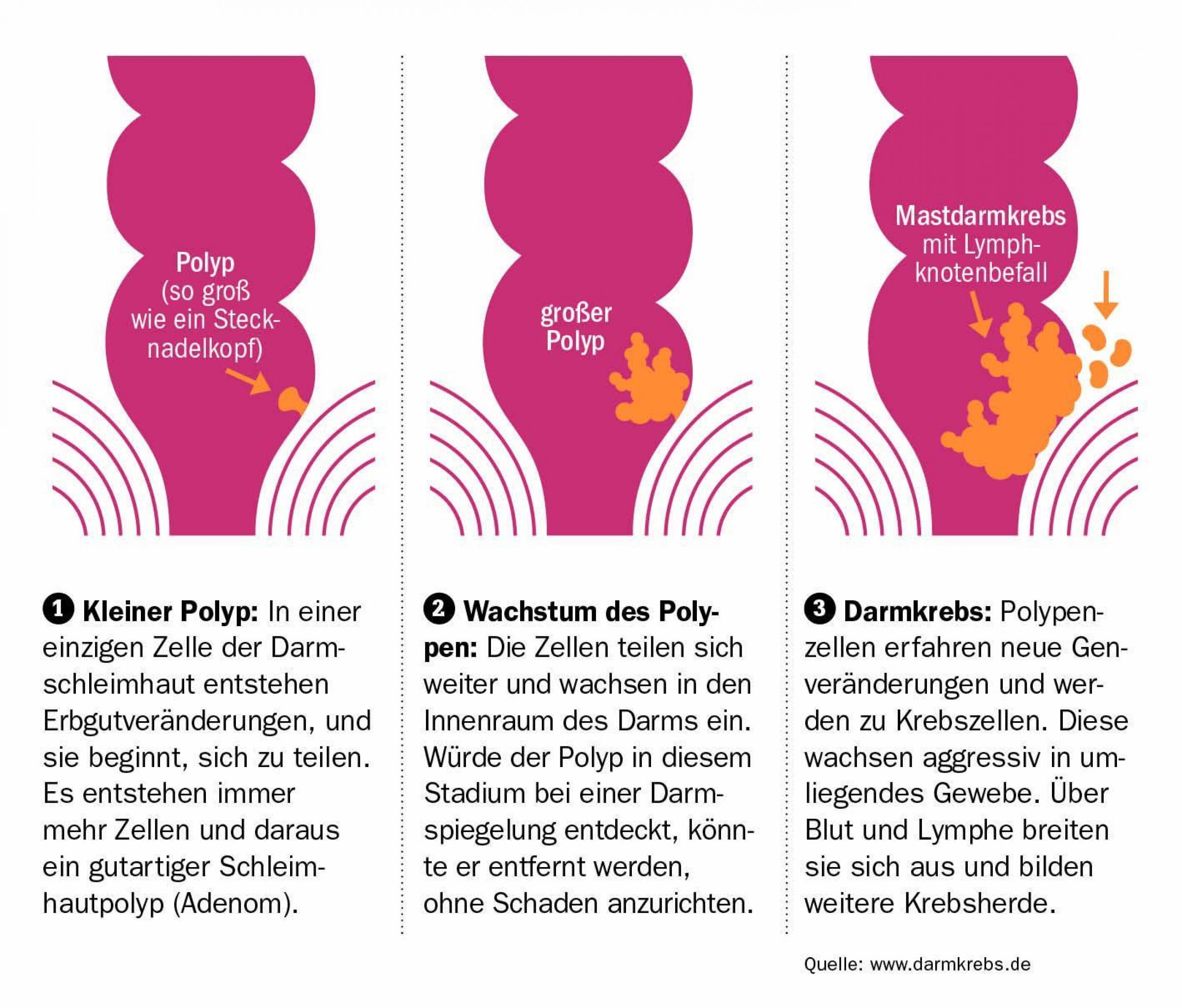 Was ist Darmkrebs? | Felix Burda Stiftung